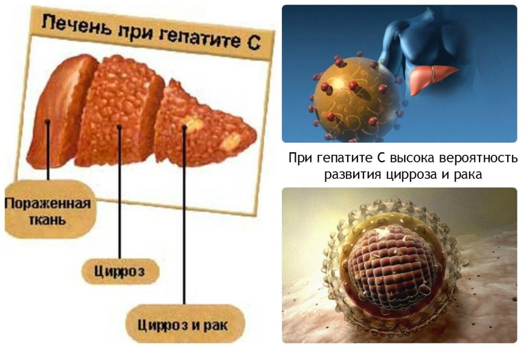 Последствия и осложнения вирусной болезни после лечения гепатита с