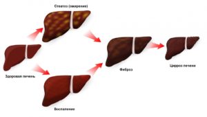 Как лечить гепатит С с фиброзом печени, факторы риска развития фиброза печени