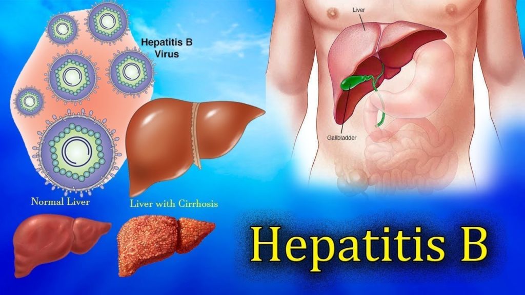 Что нужно знать о заболевании гепатита В и его лечении